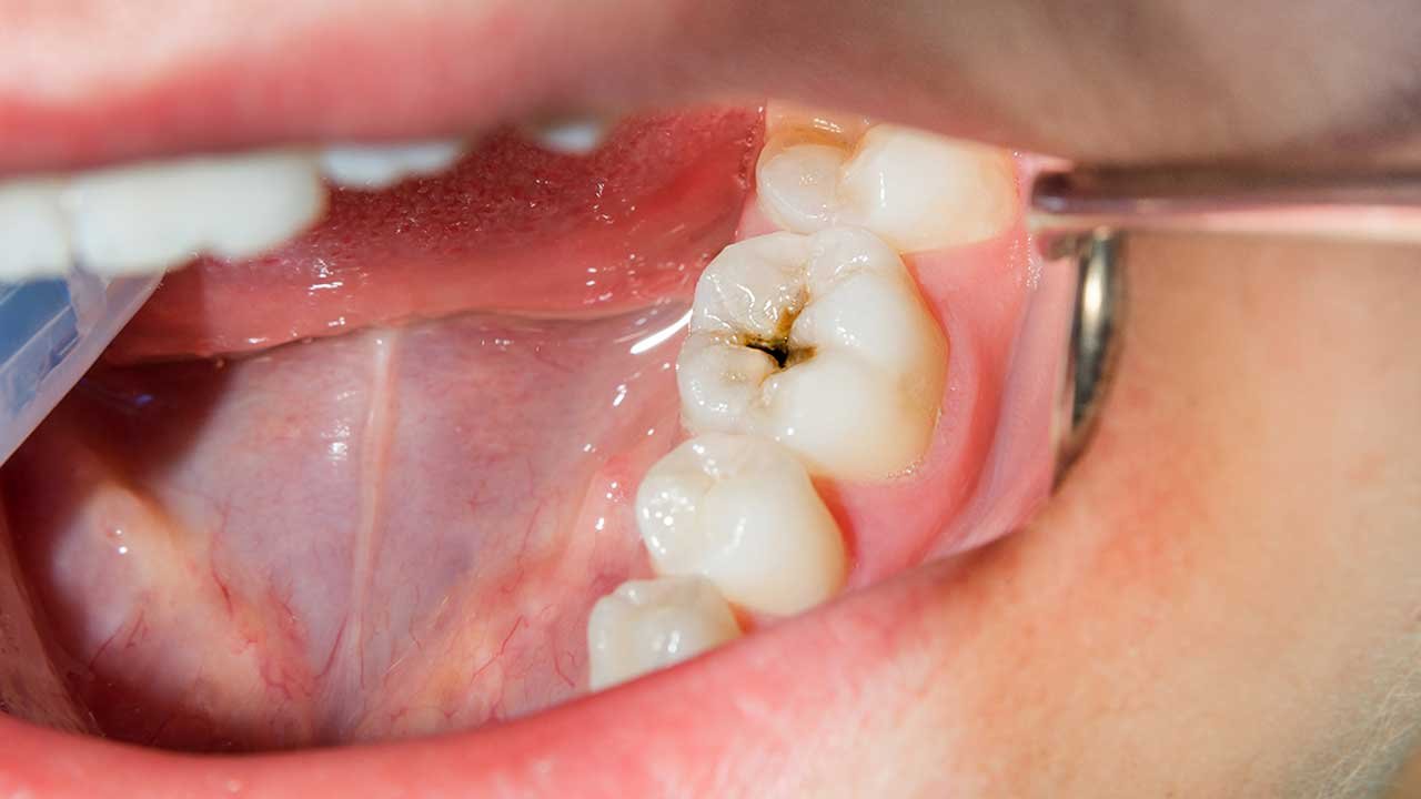 Tooth Fillings