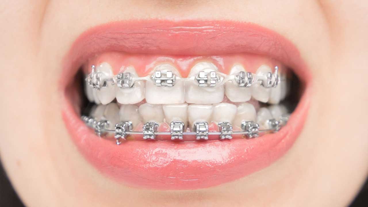 Orthodontic Treatment