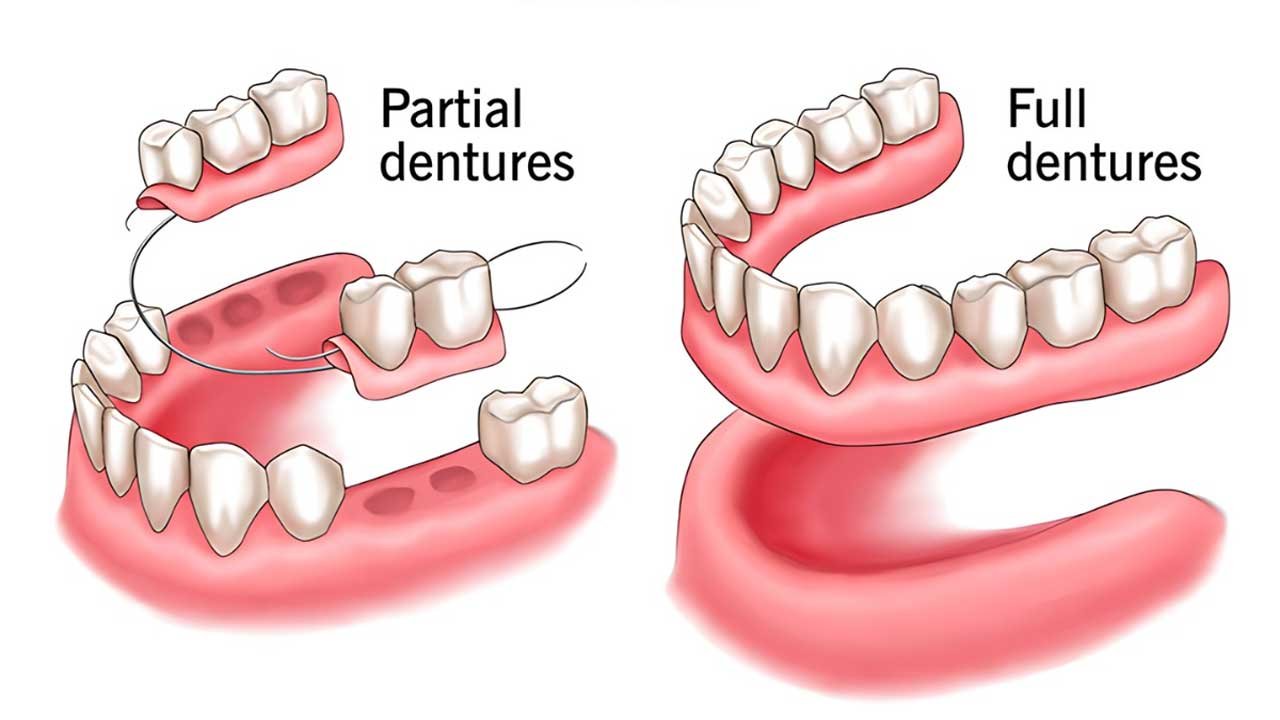 Complete & Partial Dentures