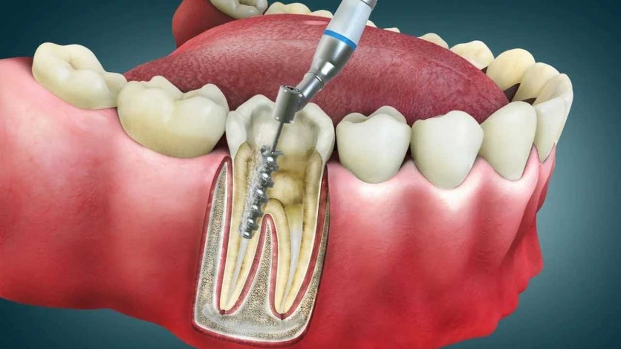 Root Canal Treatment