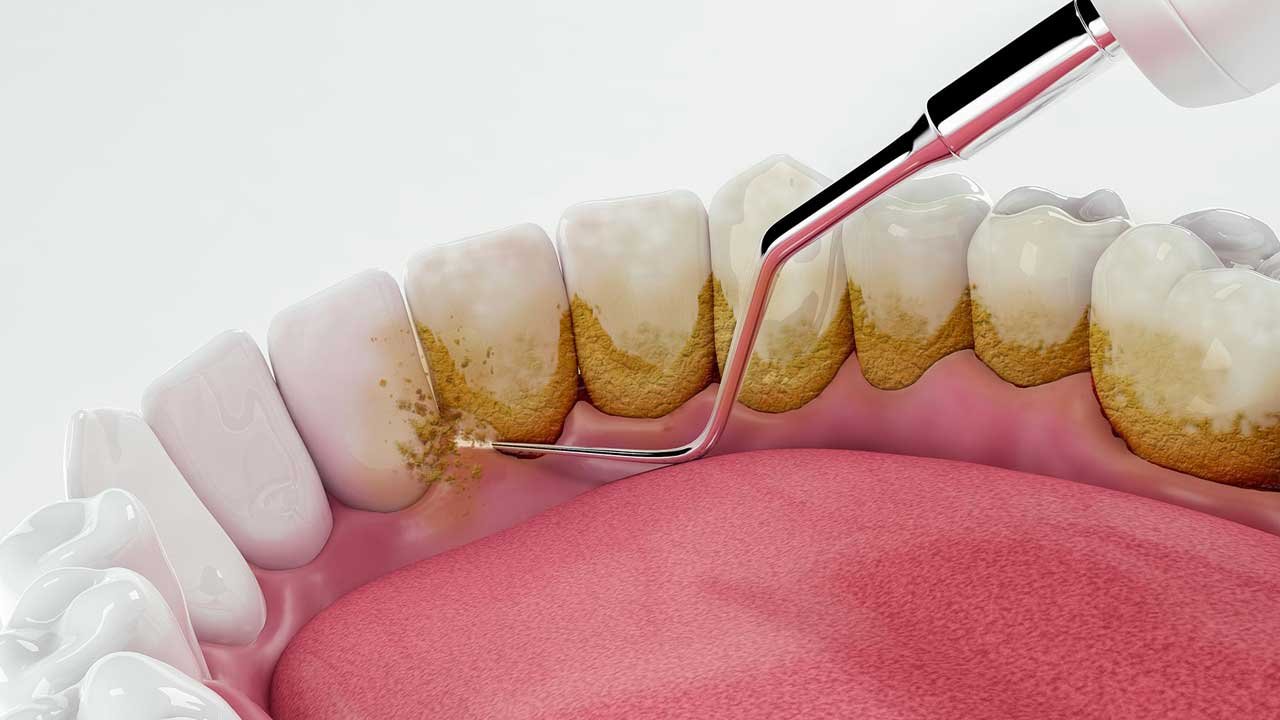 Scaling & Gum Treatment