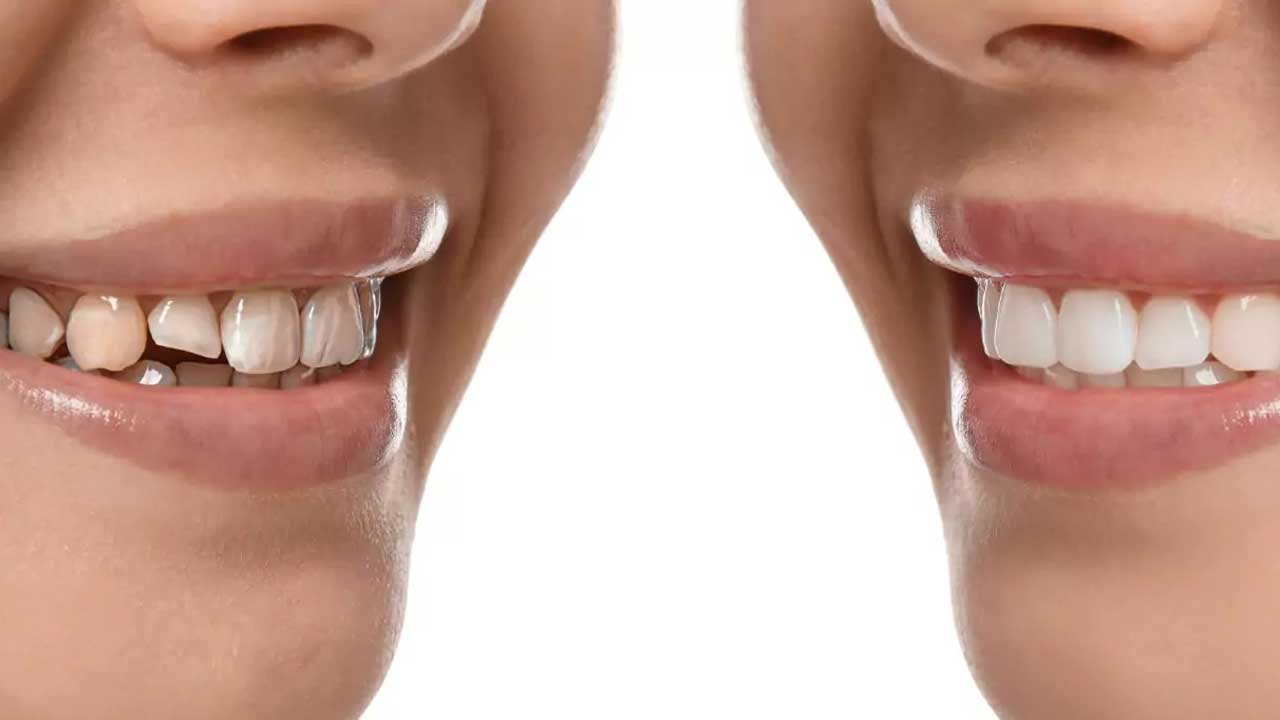 Smile Designing