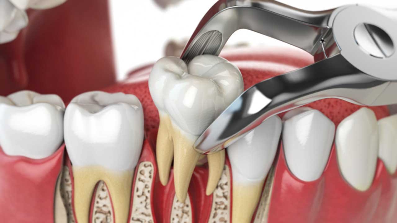 Tooth Extraction